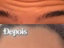 Aplicação de botox e ácido hialuronico